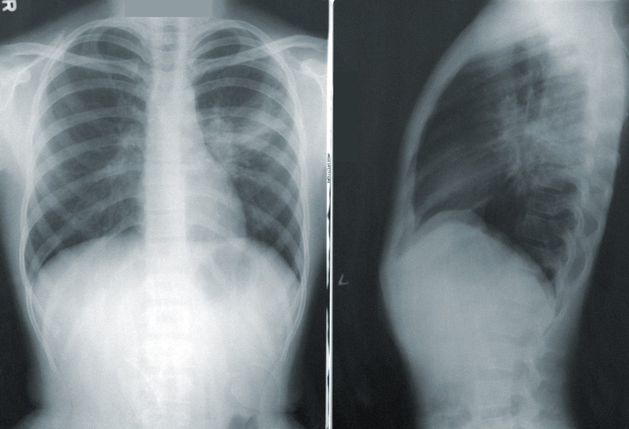 NUTRI-FOOD-PLAN-pneumonia-covid-prevencia-Teplan - Gyors fogyás szakértői felügyelet mellett | NUTRI FOOD PLAN